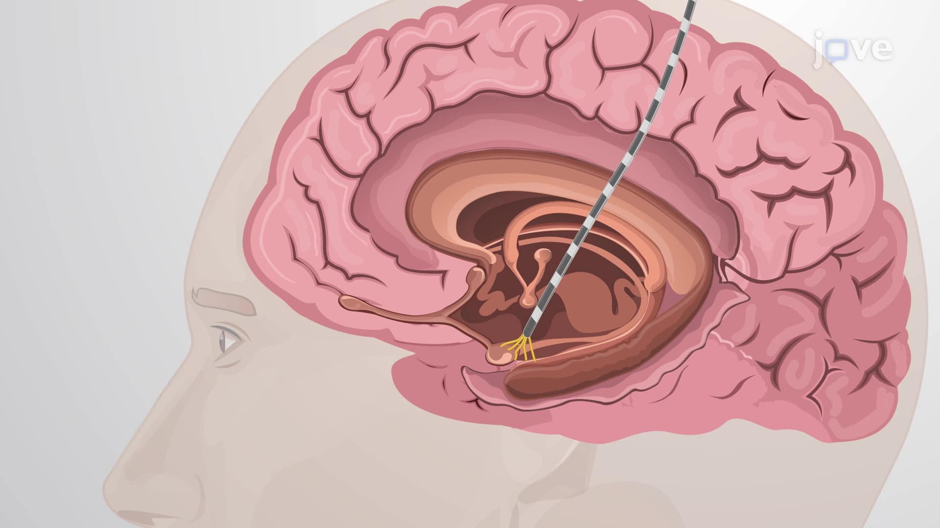 Simultaneous Eye Tracking and Single-Neuron Recording to Identify Target-Selective Neurons