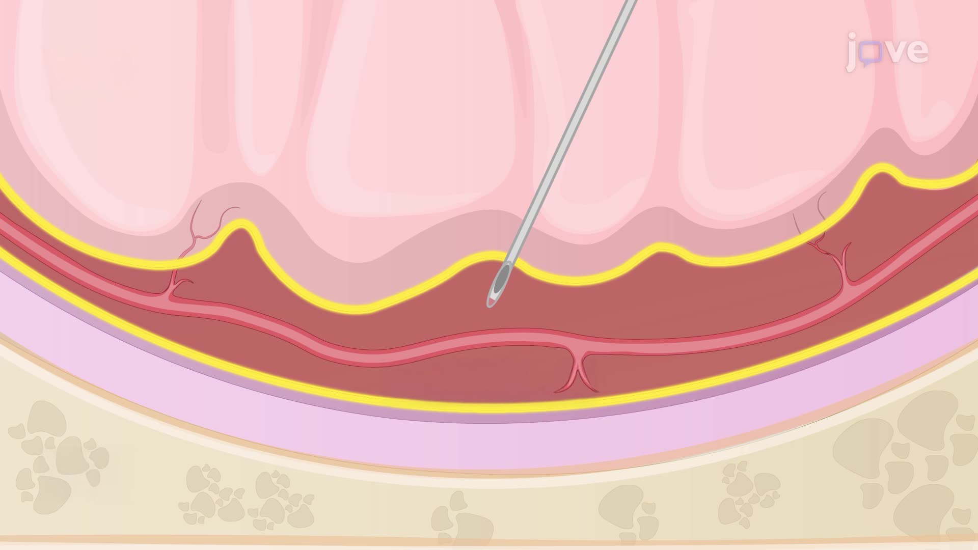 Establishing a Subarachnoid Hemorrhage Rat Model Induced by Autologous Blood Injection