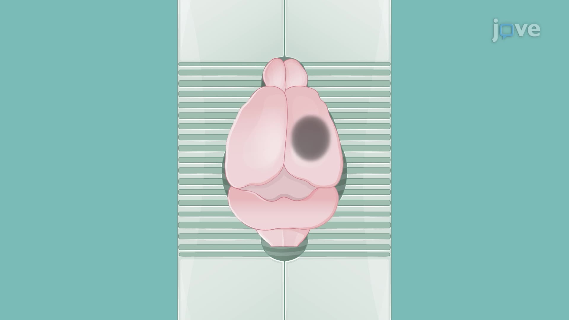 Measuring the Infarct Zone and Brain Edema in a Rat Brain Following Middle Cerebral Artery Occlusion