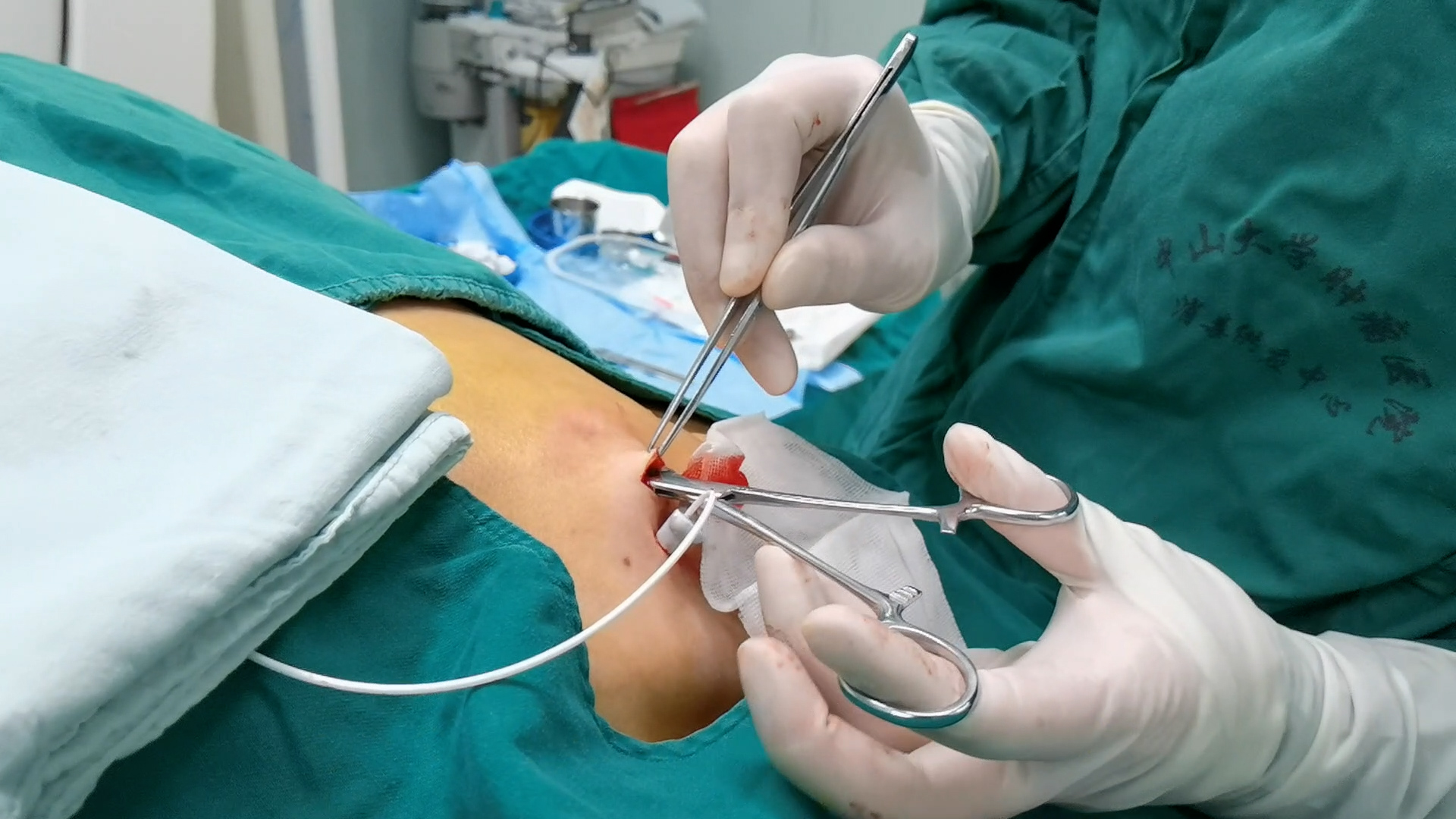 Implantation guidée par tomodensitométrie (CT) d’un port d’accès veineux totalement implantable (TIVAP) via la veine sous-clavière