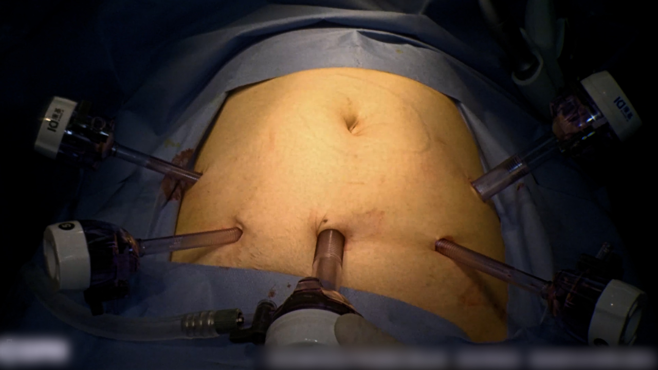 右側結腸癌に対する外科的体幹指向腹腔鏡下右半結腸切除術 (ST-LRH)