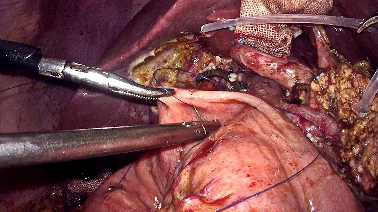 Suture continue à l’aiguille inverse du canal pancréatique à la muqueuse jéjunale Anastomose pancréatico-intestinale dans la pancréaticoduodénectomie laparoscopique