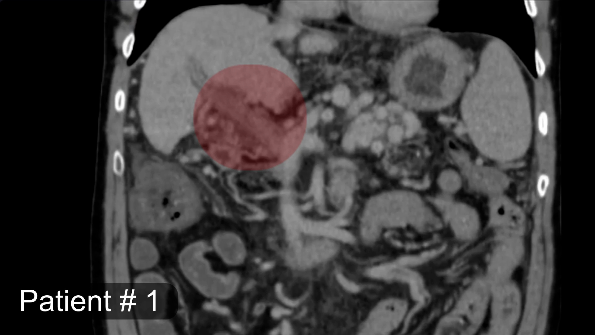 New Thrombectomy Technique for Total Portal Vein Thrombosis in Liver Transplantation