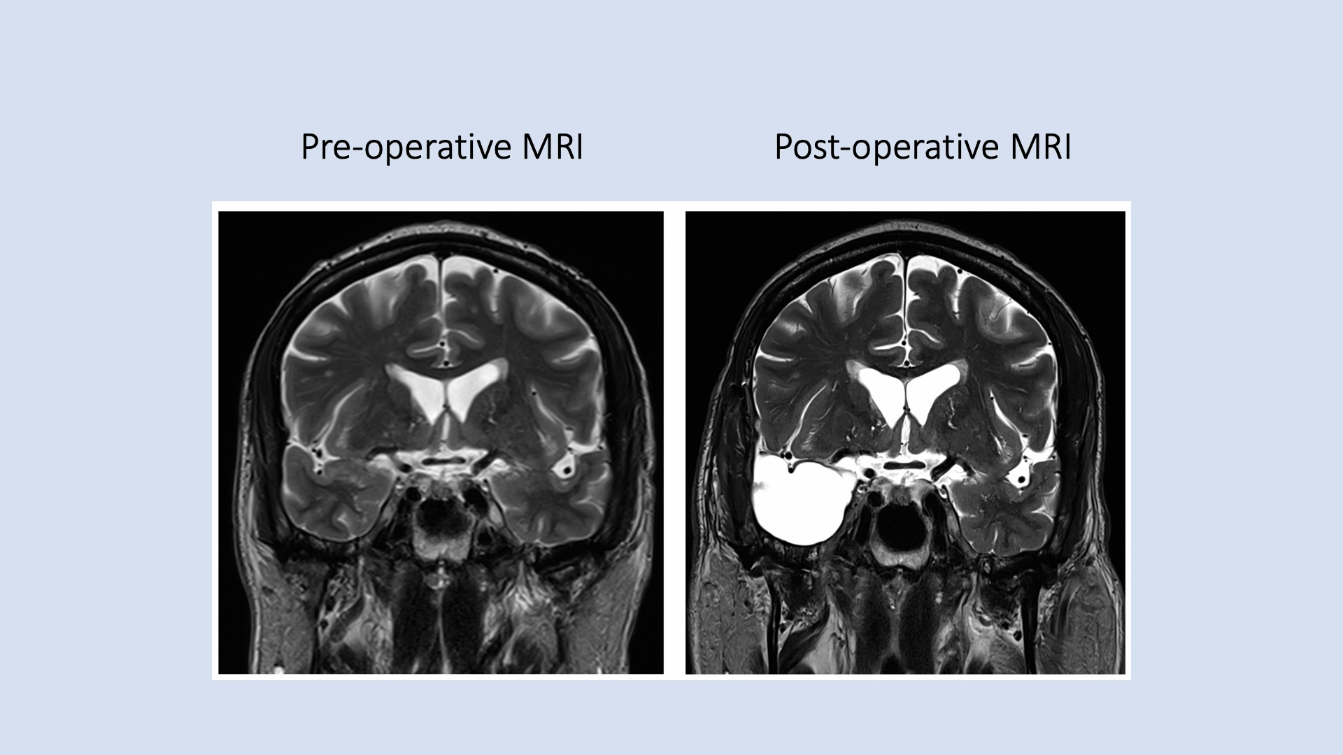 Anteromesial Temporal Lobectomy for Medically Intractable Temporal Lobe Epilepsy: An Operative Study