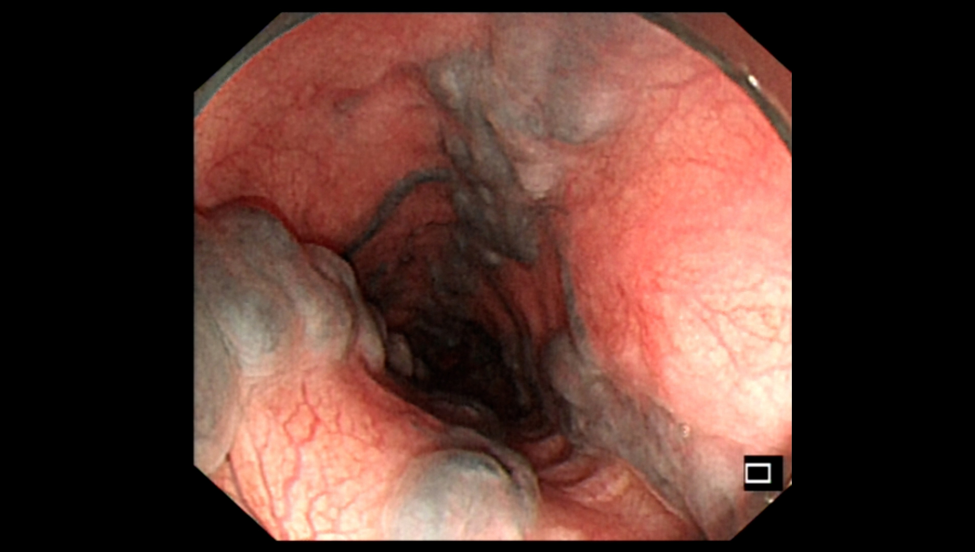 Underwater Endoscopic Injection Sclerotherapy for Gastroesophageal Varices