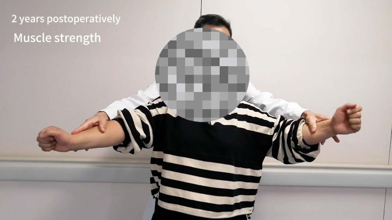 Modified Long Head of Biceps Tendon Rerouting and Fixation as Partial Capsular Reconstruction for Massive Irreparable Rotator Cuff Tears
