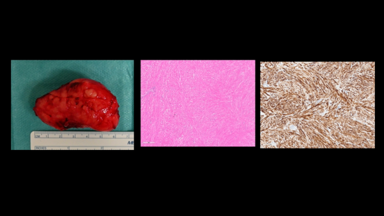 食管平滑肌瘤的机器人摘除
