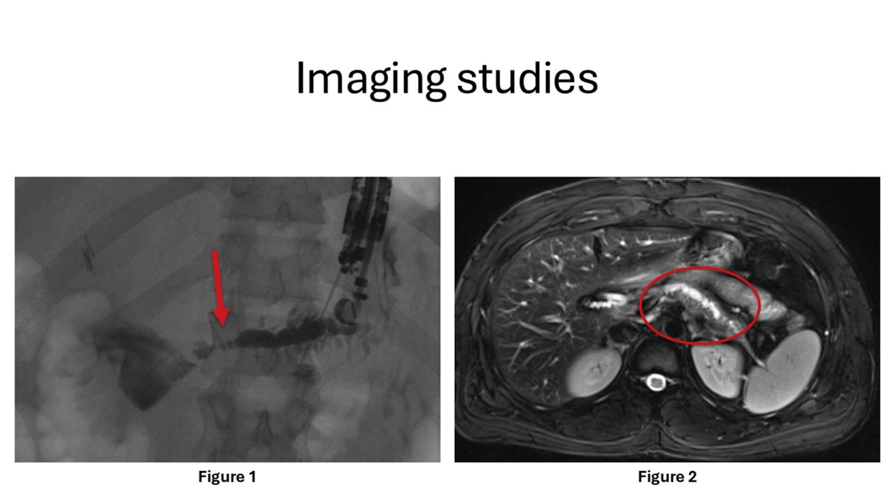 Robotic-assisted Lateral Pancreaticojejunostomy for Chronic Pancreatitis