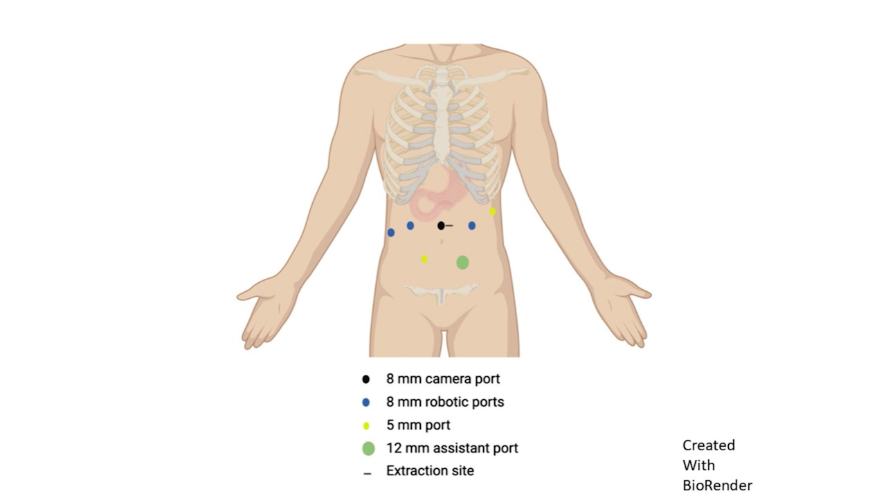 Robotic Duodenal Sleeve Resection for Gastrointestinal Stromal Tumor with Rare Exon 8 KIT Mutation Following Neoadjuvant Imatinib
