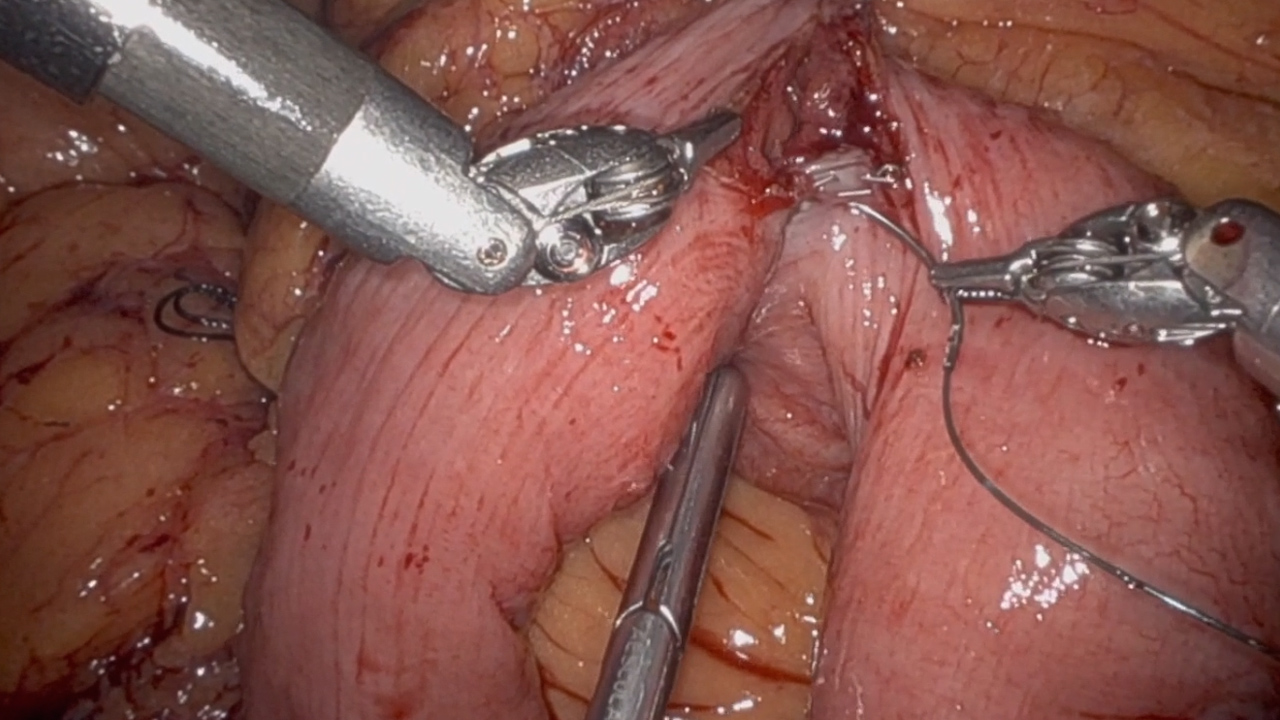 Intraoperative Video Consultation Following Bile Duct Transection Facilitates Direct OR Transfer for Robotic Hepaticojejunostomy at Tertiary Center