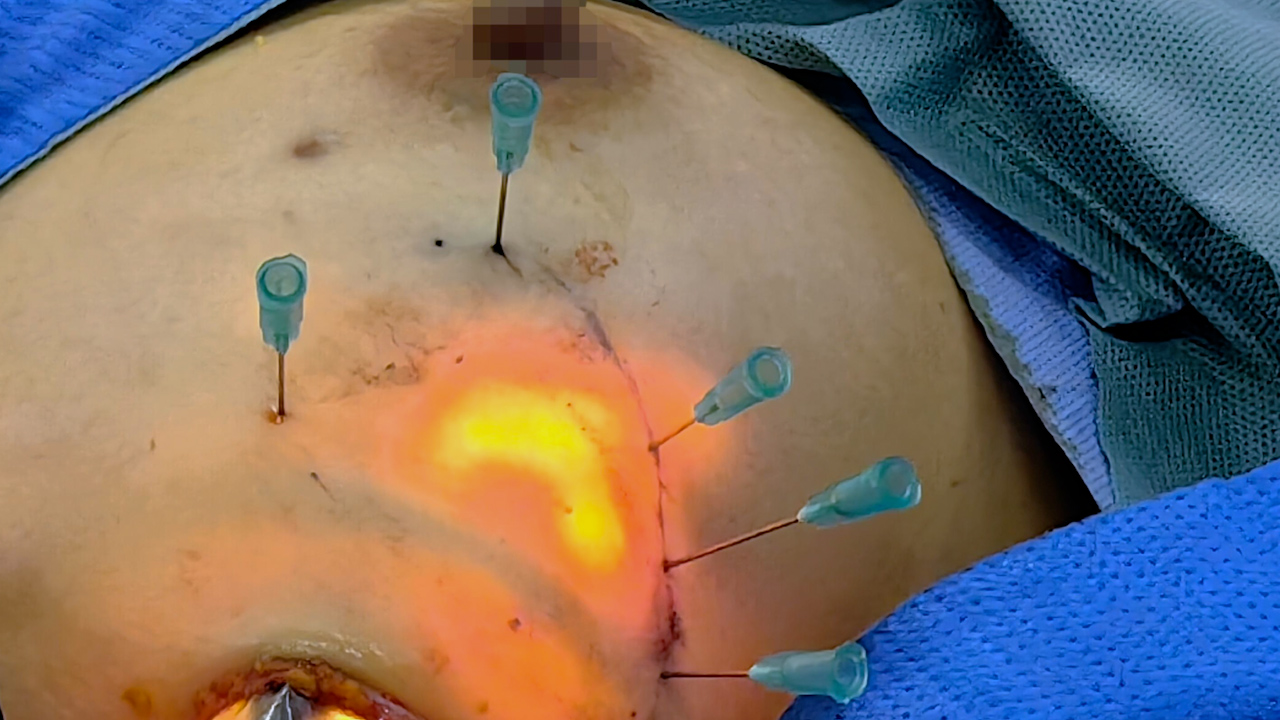 Single-Port Robotic-assisted Transaxillary Breast-conserving Surgery: A Prospective, Single-arm, Non-randomized Phase IIa Clinical Trial