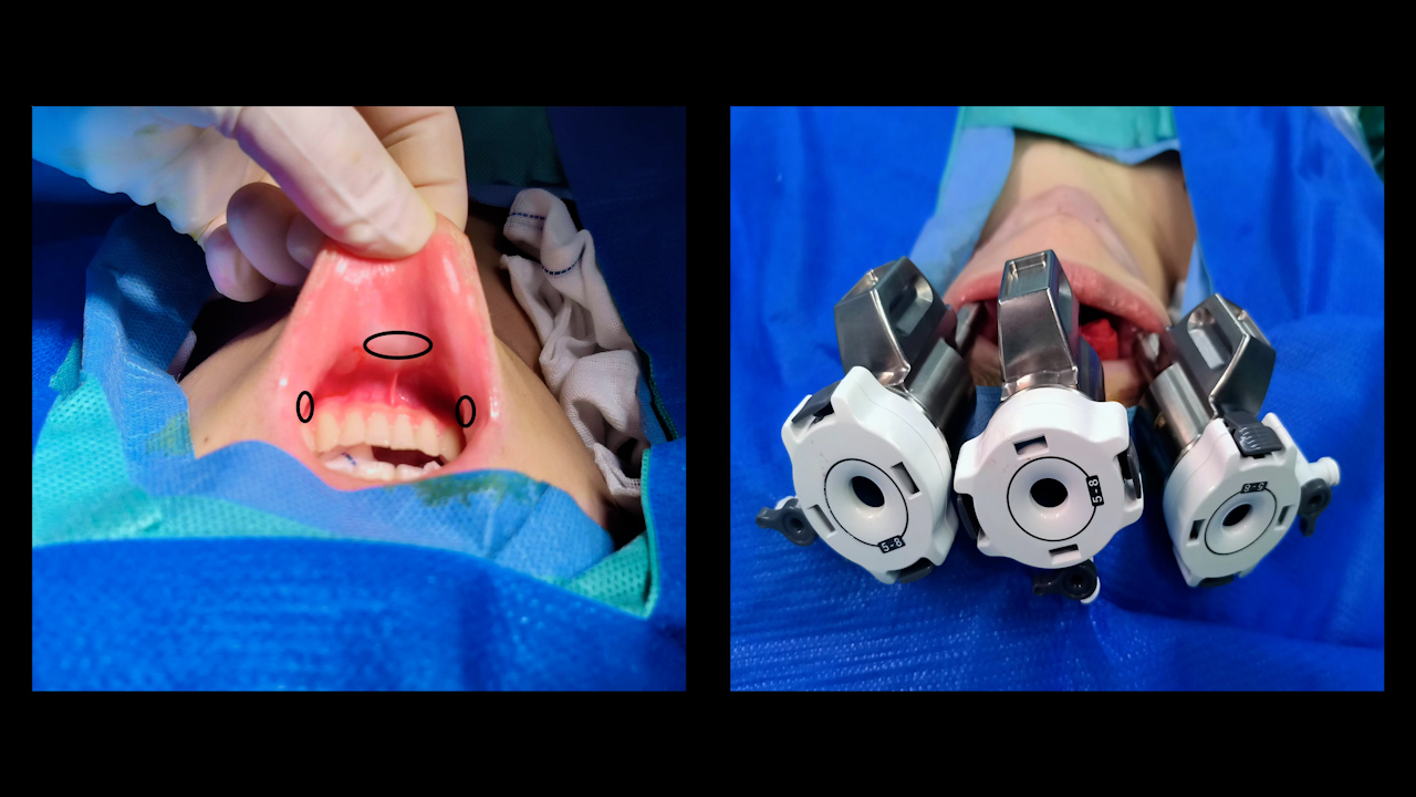Identification and Protection of the Recurrent Laryngeal Nerve during Transoral Robotic Thyroidectomy