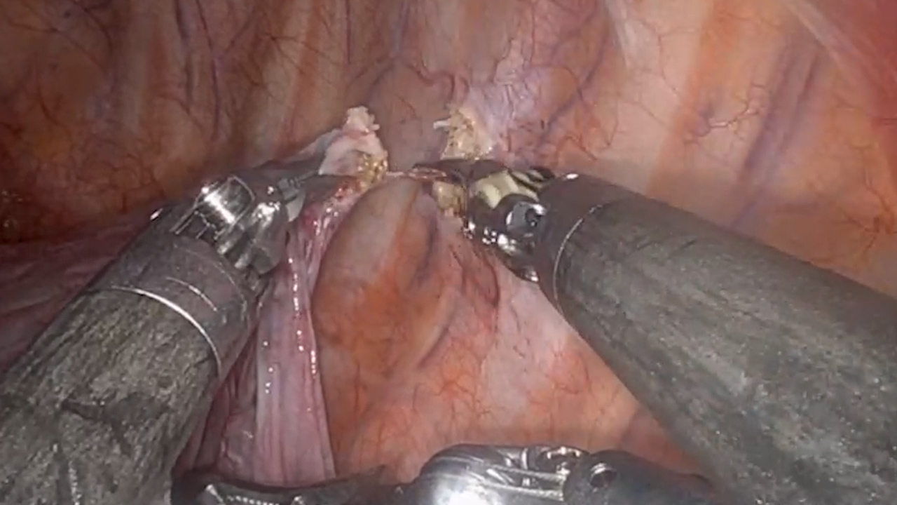Robotic-assisted Left Pneumonectomy For Vanishing Lung Syndrome
