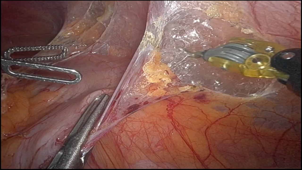 Robot-assisted Partial Splenectomy