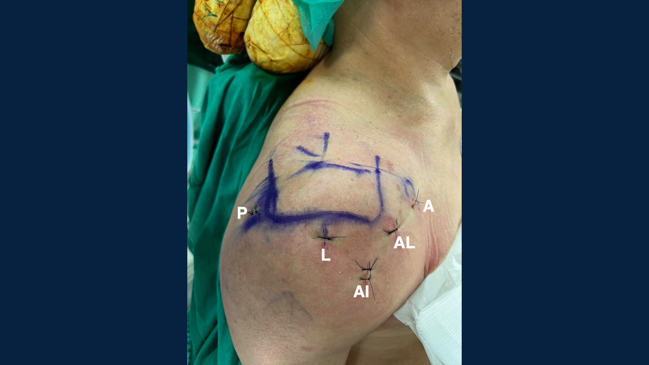 Knotless Independent Double-Row Repair and Biceps Augmentation for Anterosuperior Rotator Cuff Tears