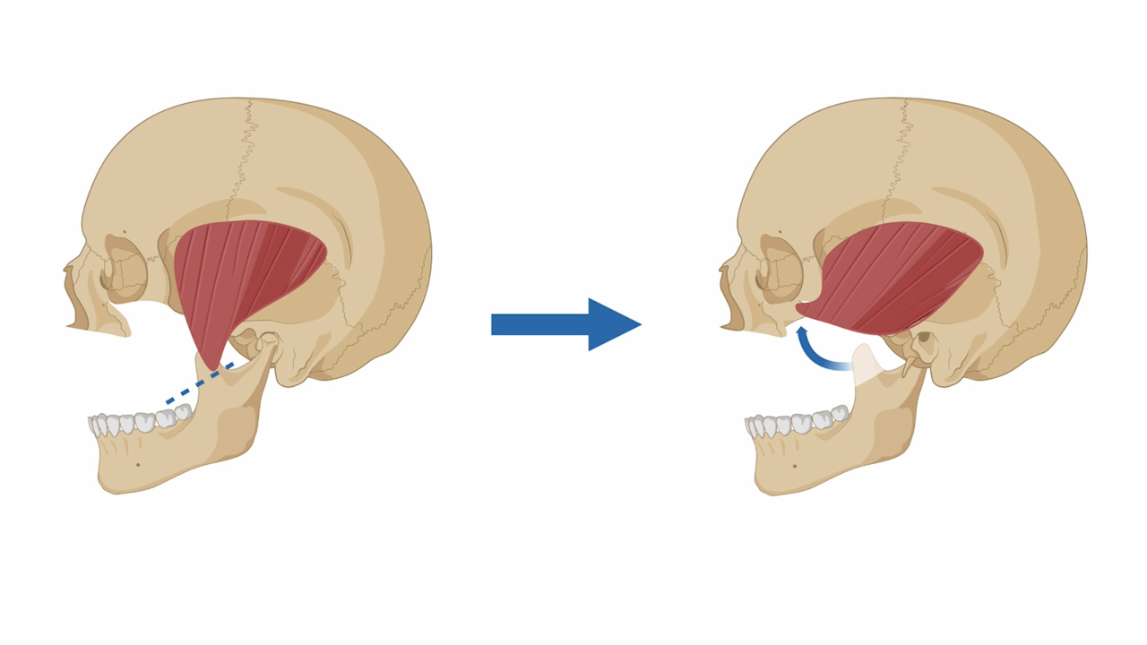 Coronoid-Temporalis Pedicled Flap for Orbital Floor Defect Reconstruction