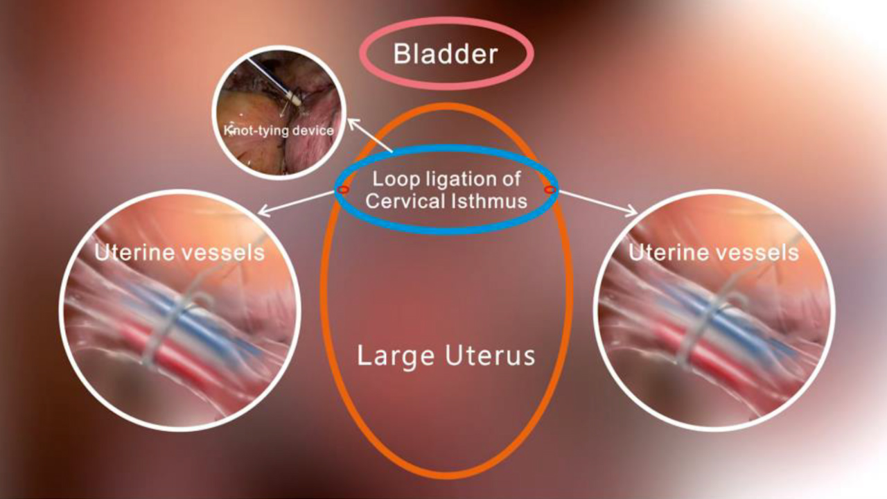Laparoscopic Extracorporeal Knot-Tying for Uterine Vessel Occlusion during Hysterectomy with Cervical Cerclage in Large Uteri