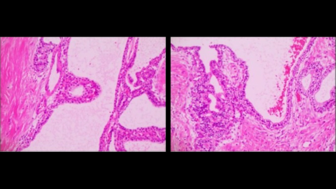 采用腹腔镜中央胰切除术并端到端胰管重建治疗中段良性胰腺肿瘤