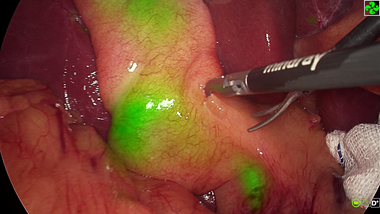 Laparoscopic Cholecystectomy with Indocyanine Green Fluorescence: Choledochoscopic Stone Extraction and Primary Duct Suture