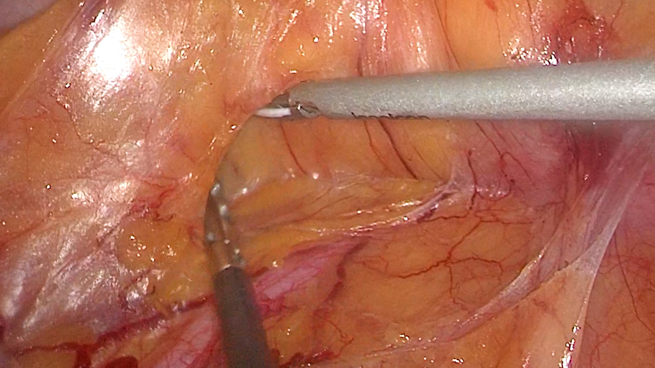 Kaudal-zu-Schädel-Ansatz bei laparoskopischer rechter Hemikolektomie mit vollständiger Mesokolon-Exzision und D3-Lymphknotendissektion