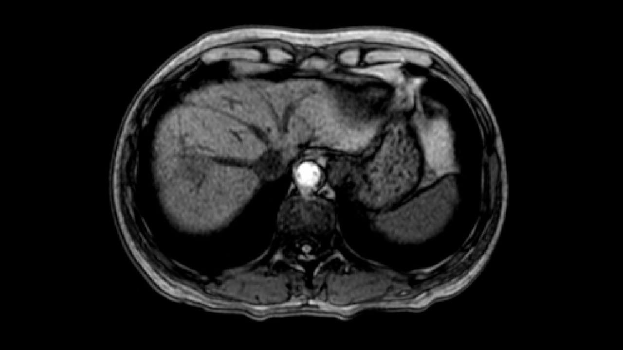 Laparoscopic Anatomic S7+S8d Resection Preserving Inferior Right Hepatic Vein and S6 with Right Hepatic Vein Transection