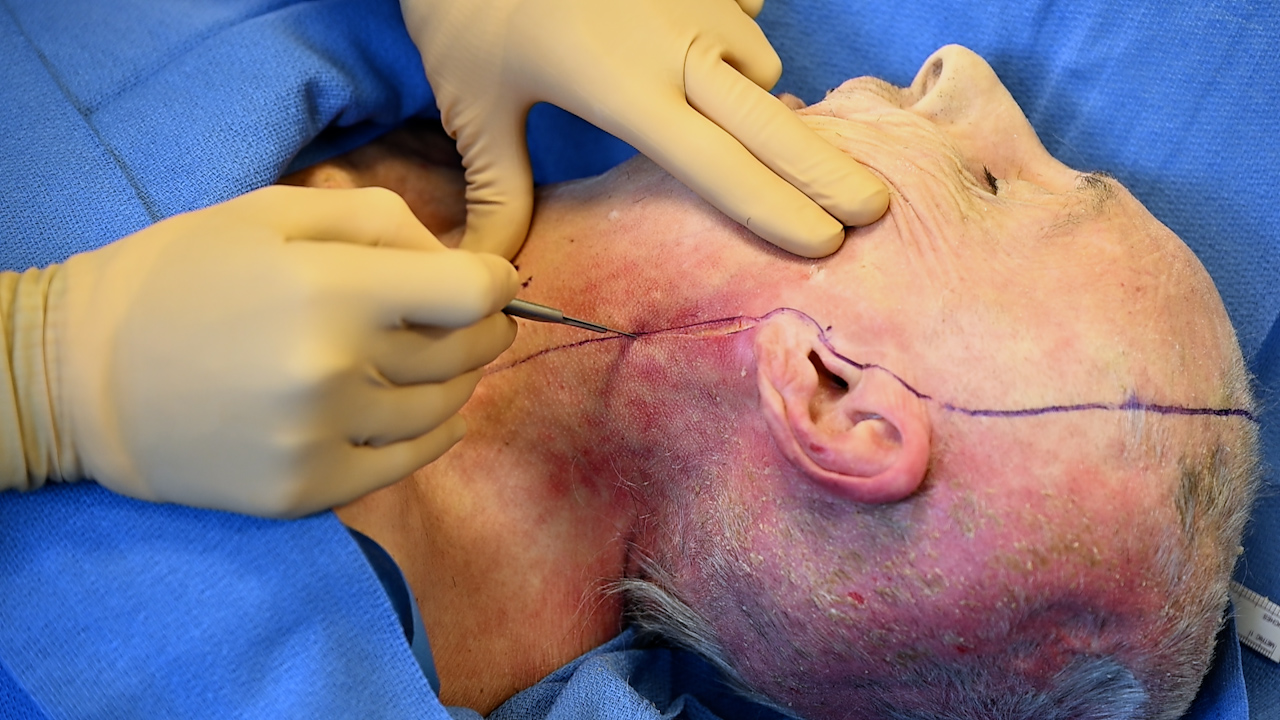 Surgical Approach to Full Soft Tissue Face Allograft Procurement for Vascularized Composite Allotransplantation