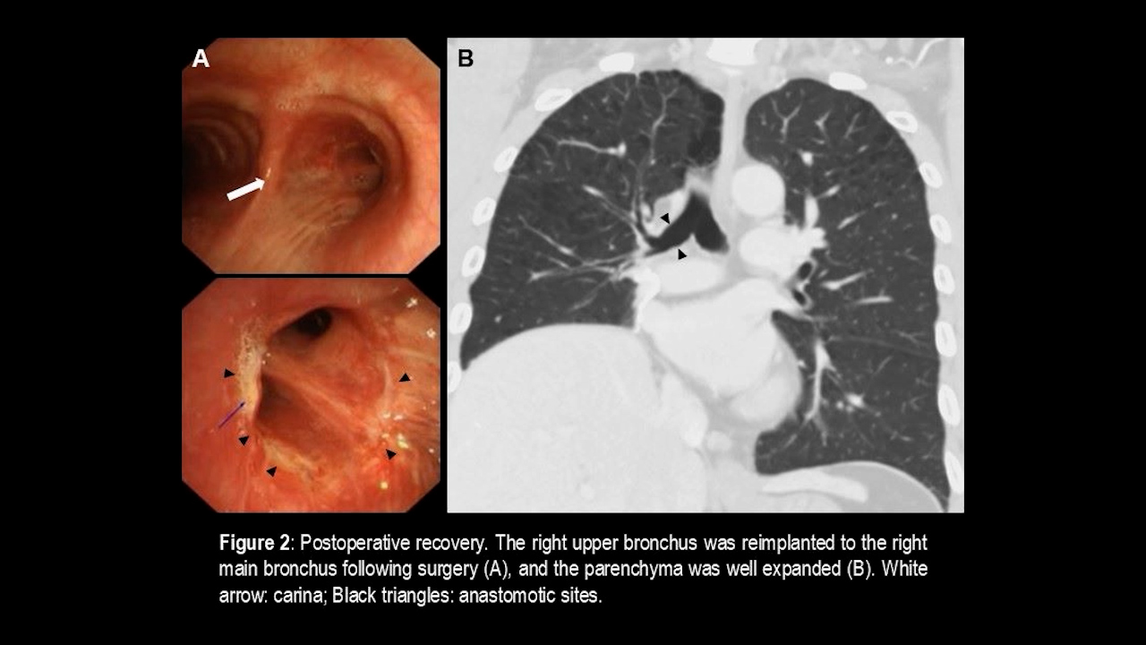 Thoracoscopic Extended Right Middle Plus Lower Sleeve Lobectomy for Non-Small-Cell Lung Cancer