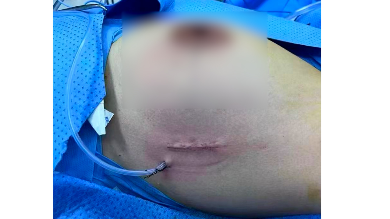 Single-port Non-liposuction Endoscopic Axillary Lymph Node Dissection ...