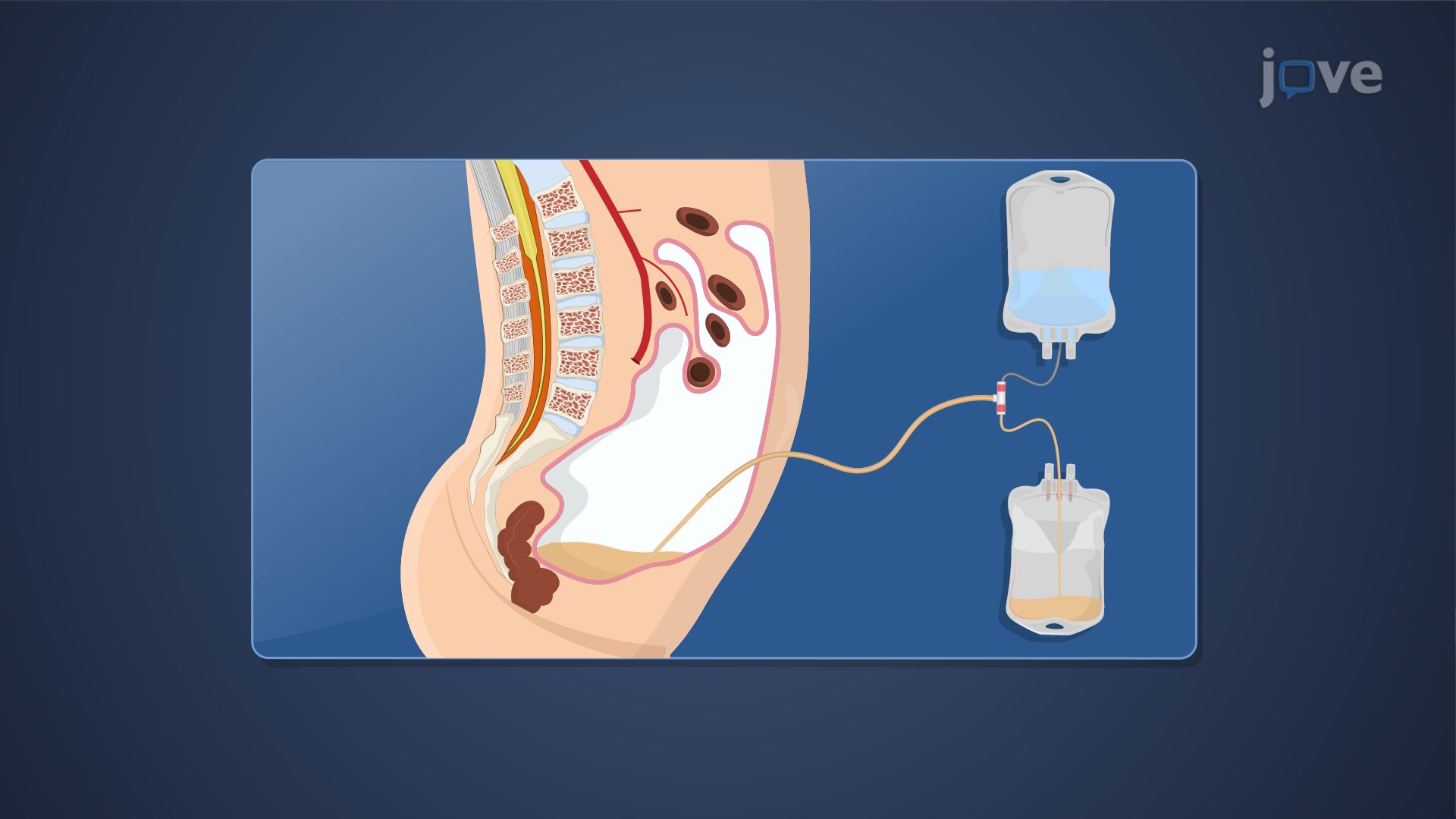 Extracorporeal Removal of Drugs: Peritoneal Dialysis and Hemodialysis