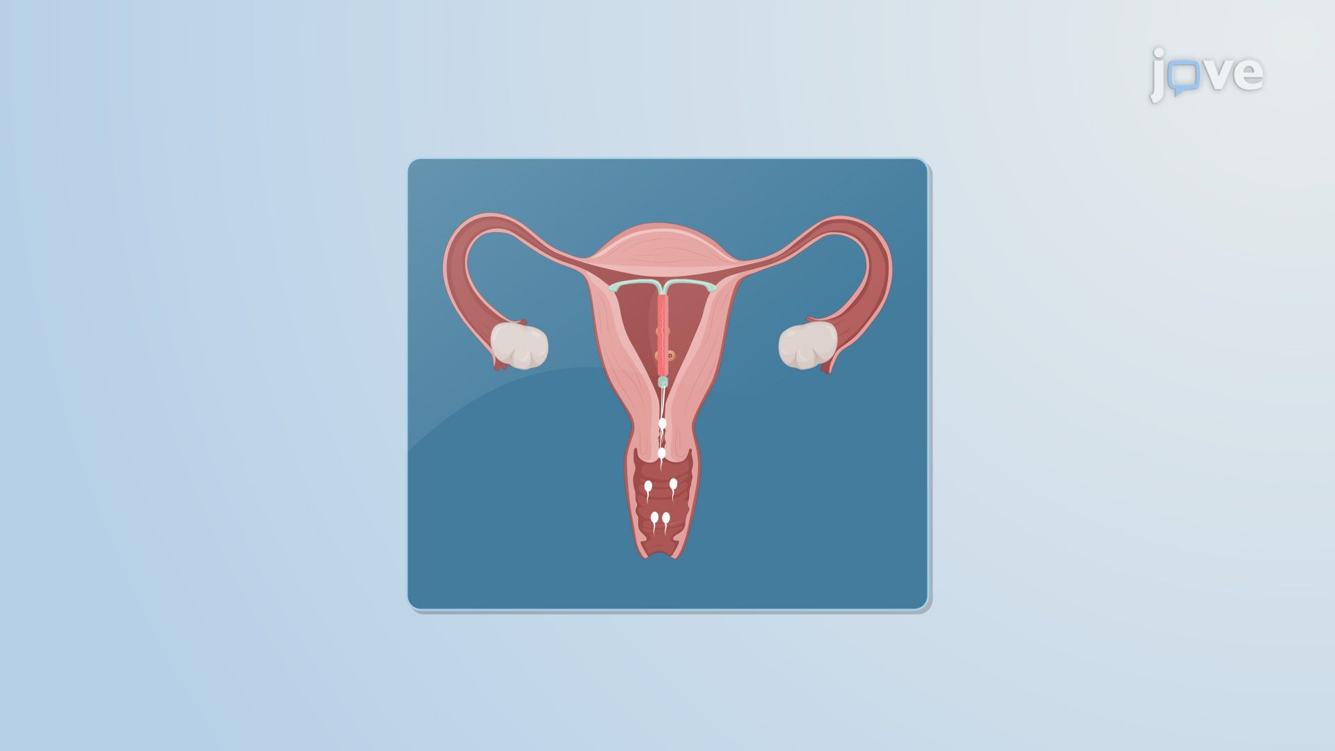 Intrauterine Drug Delivery Systems
