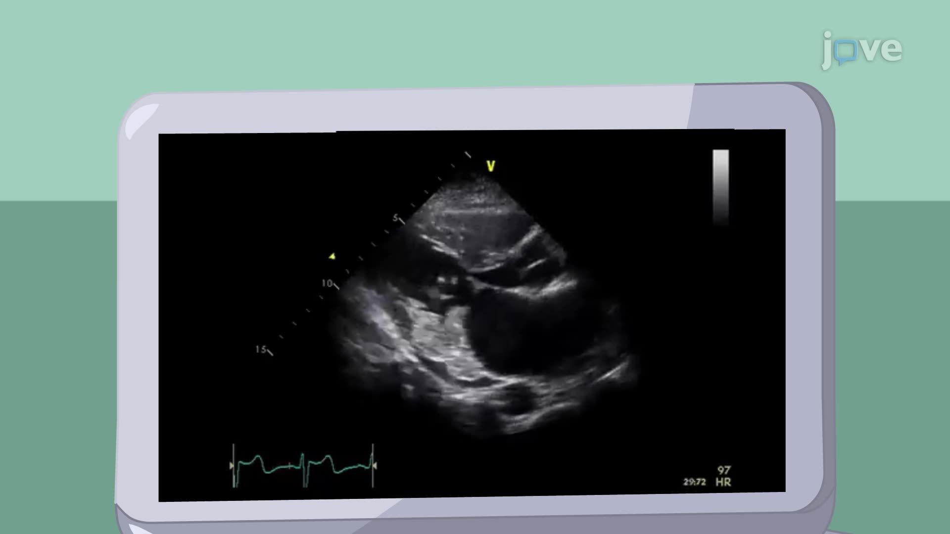 Mitral Valve Prolapse II: Assessment and Management