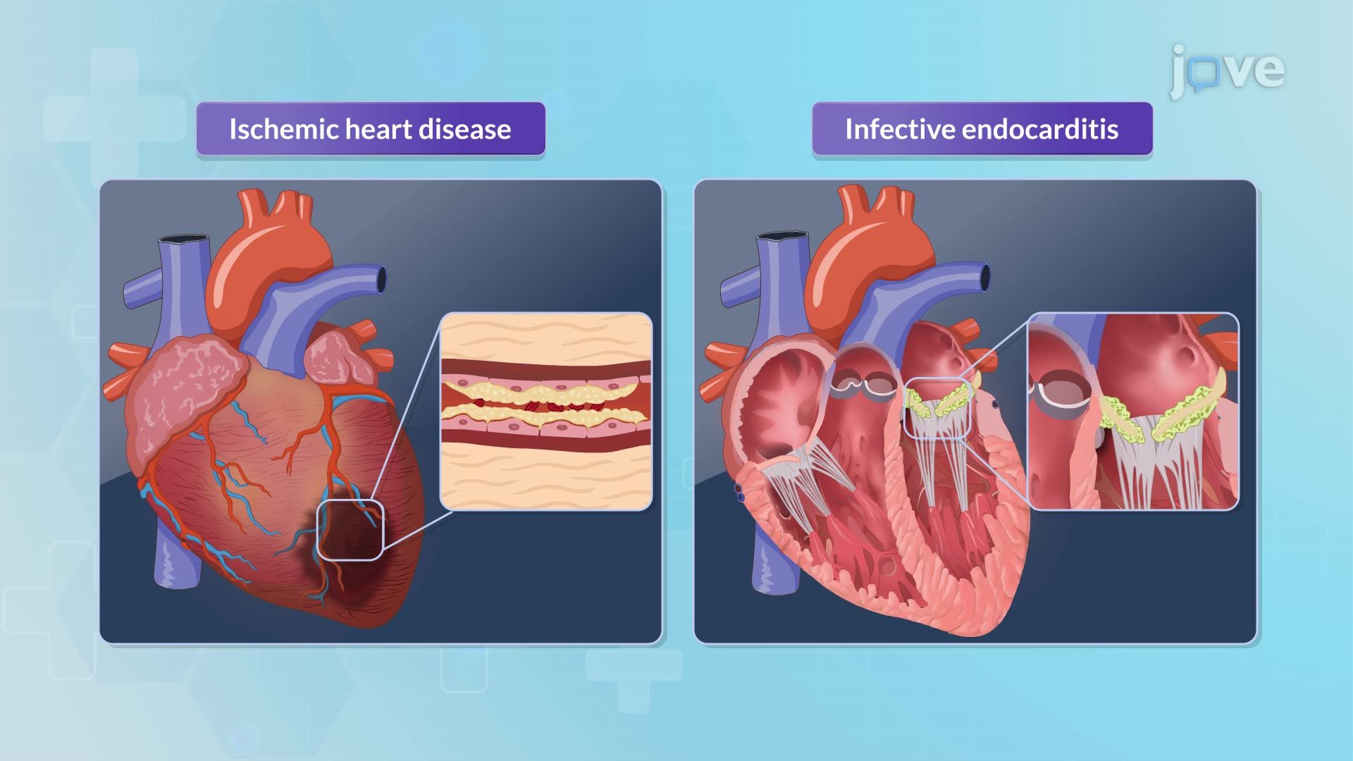 Mitral Regurgitation I: Introduction