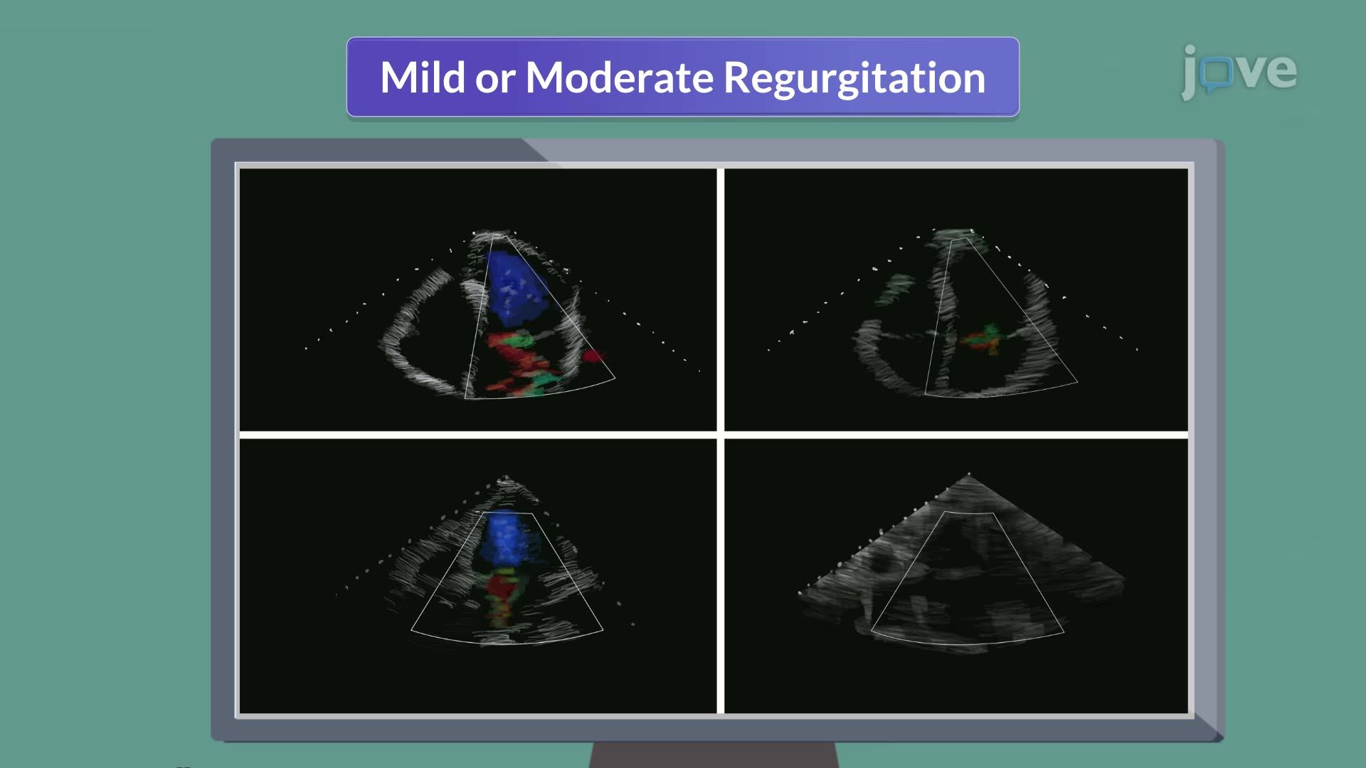 Mitral Regurgitation III: Medical Management