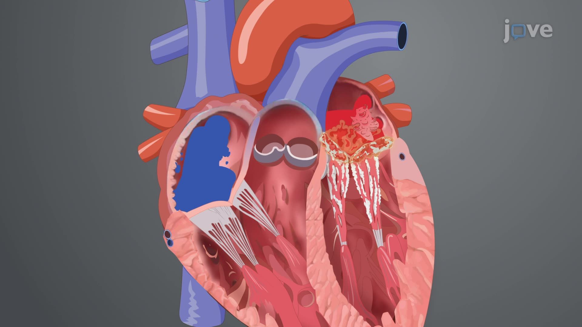 Mitral Stenosis I: Introduction
