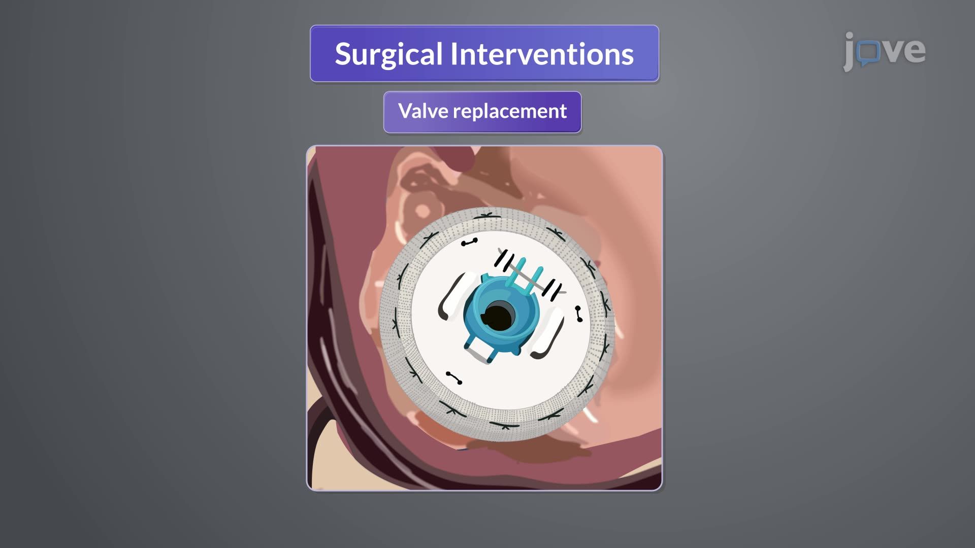 Mitral Stenosis III: Medical Management