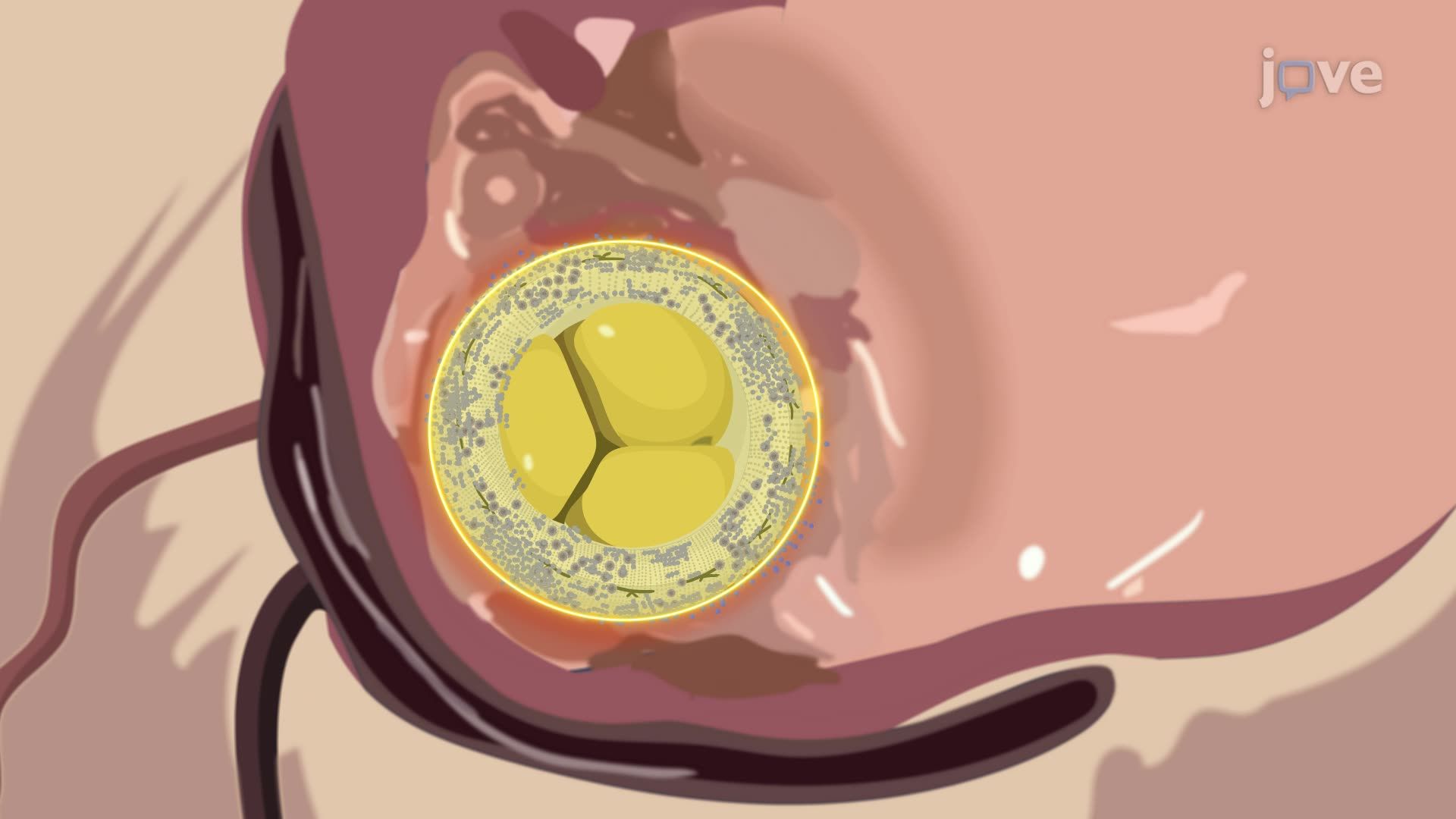 Endocarditis I: Introduction