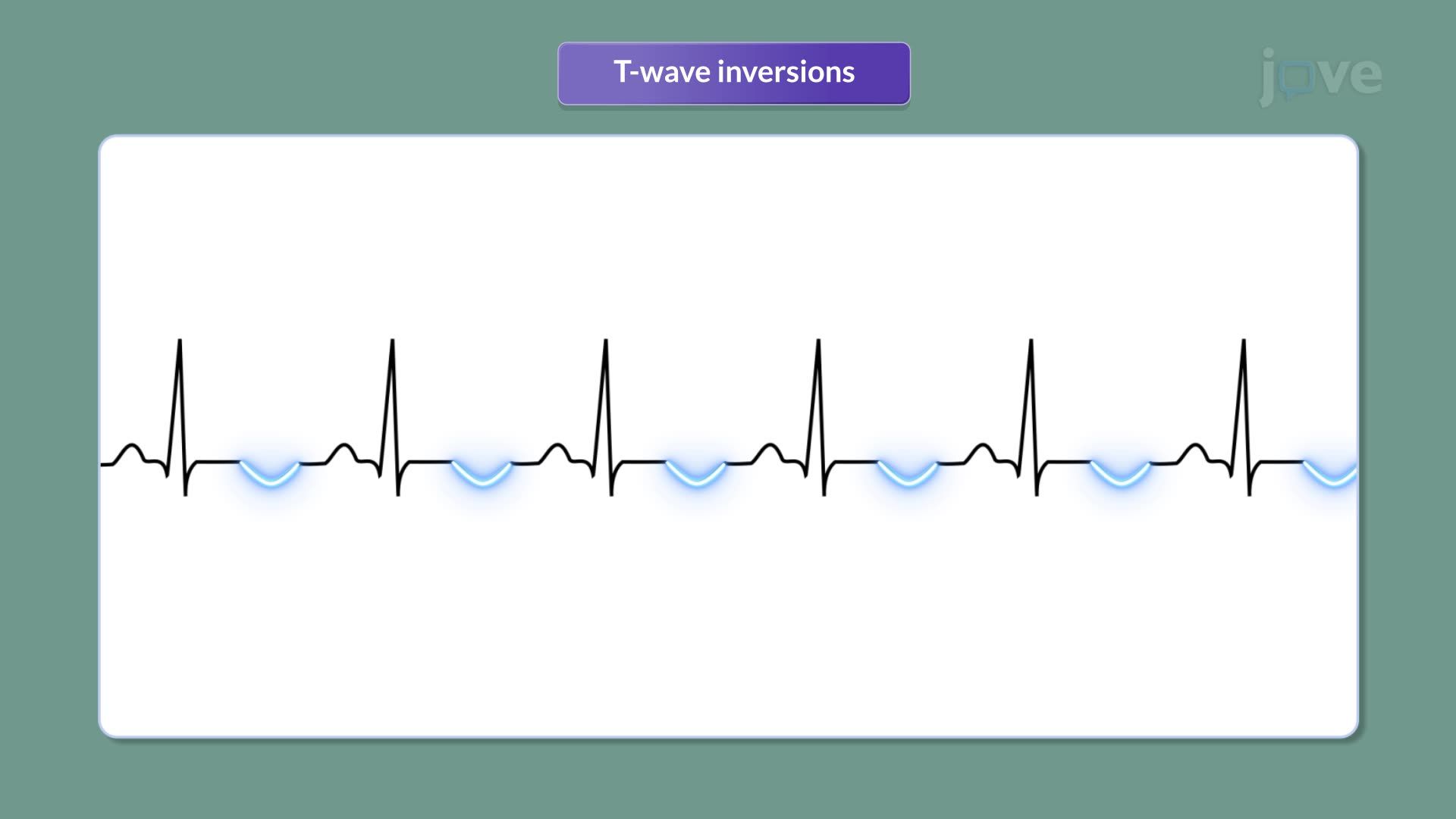 Myocarditis II: Clinical Features and Diagnostic Tests