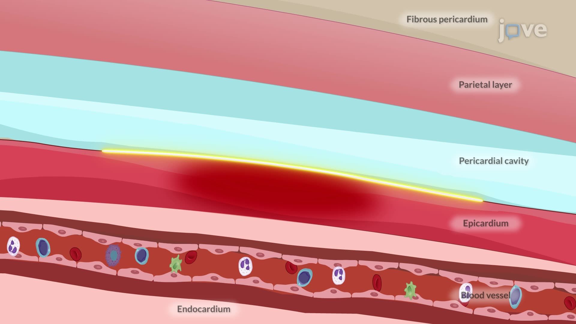 Pericarditis I: Introduction