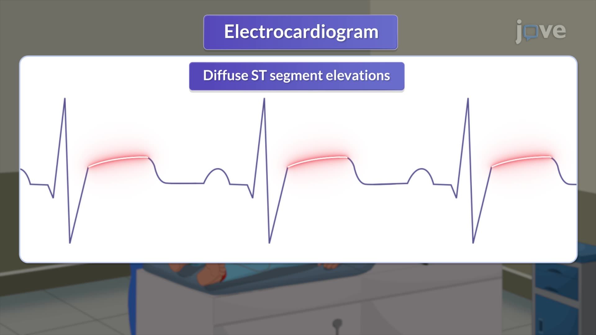 Pericarditis II: Clinical Features and Diagnostic Tests