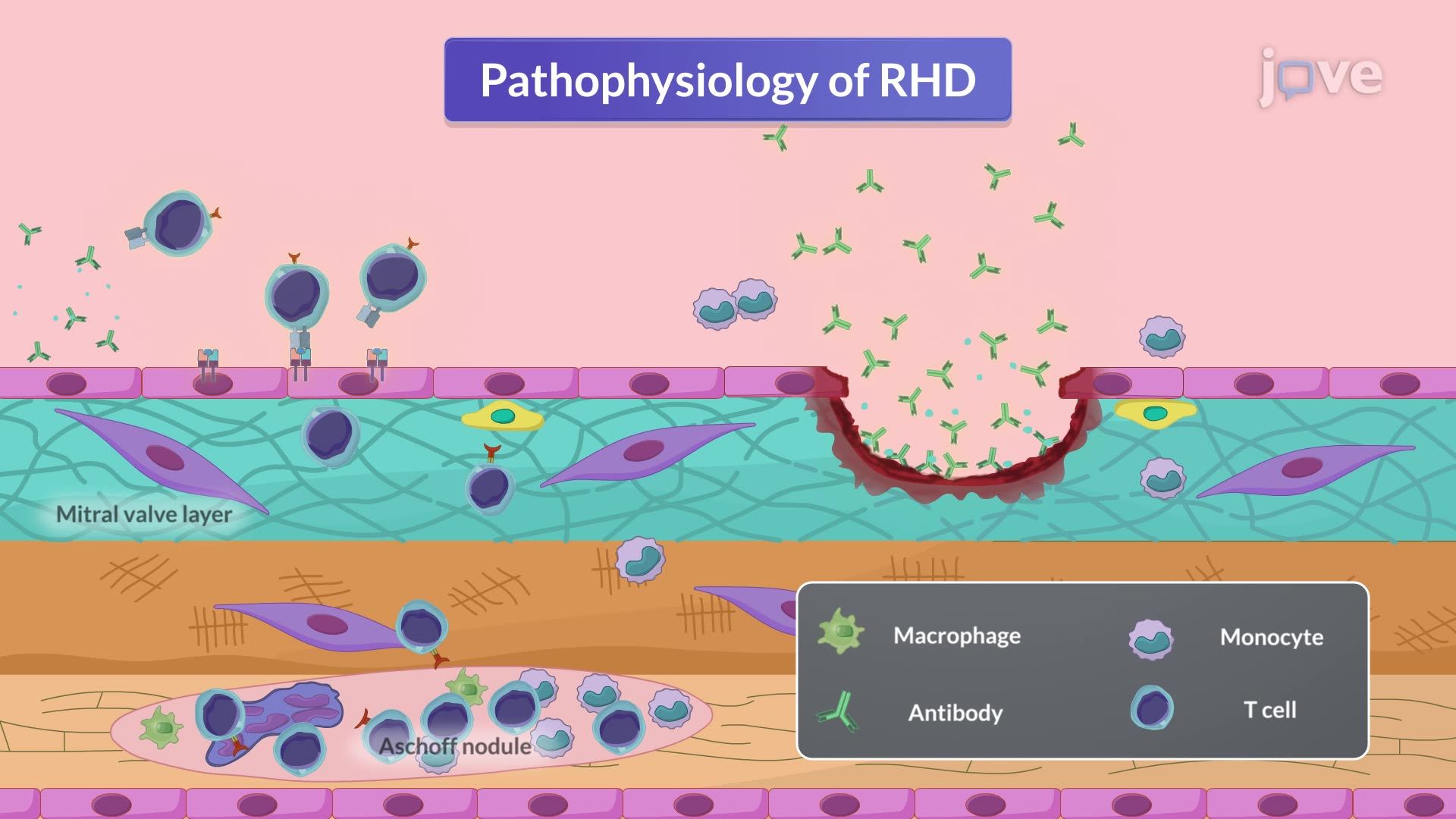 Rheumatic Heart Disease I: Introduction