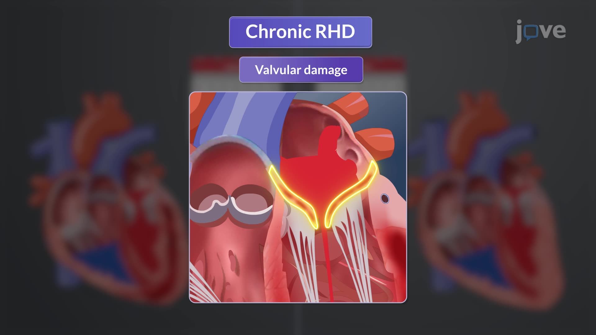 Rheumatic Heart Disease II: Clinical Manifestations and Diagnostic Studies