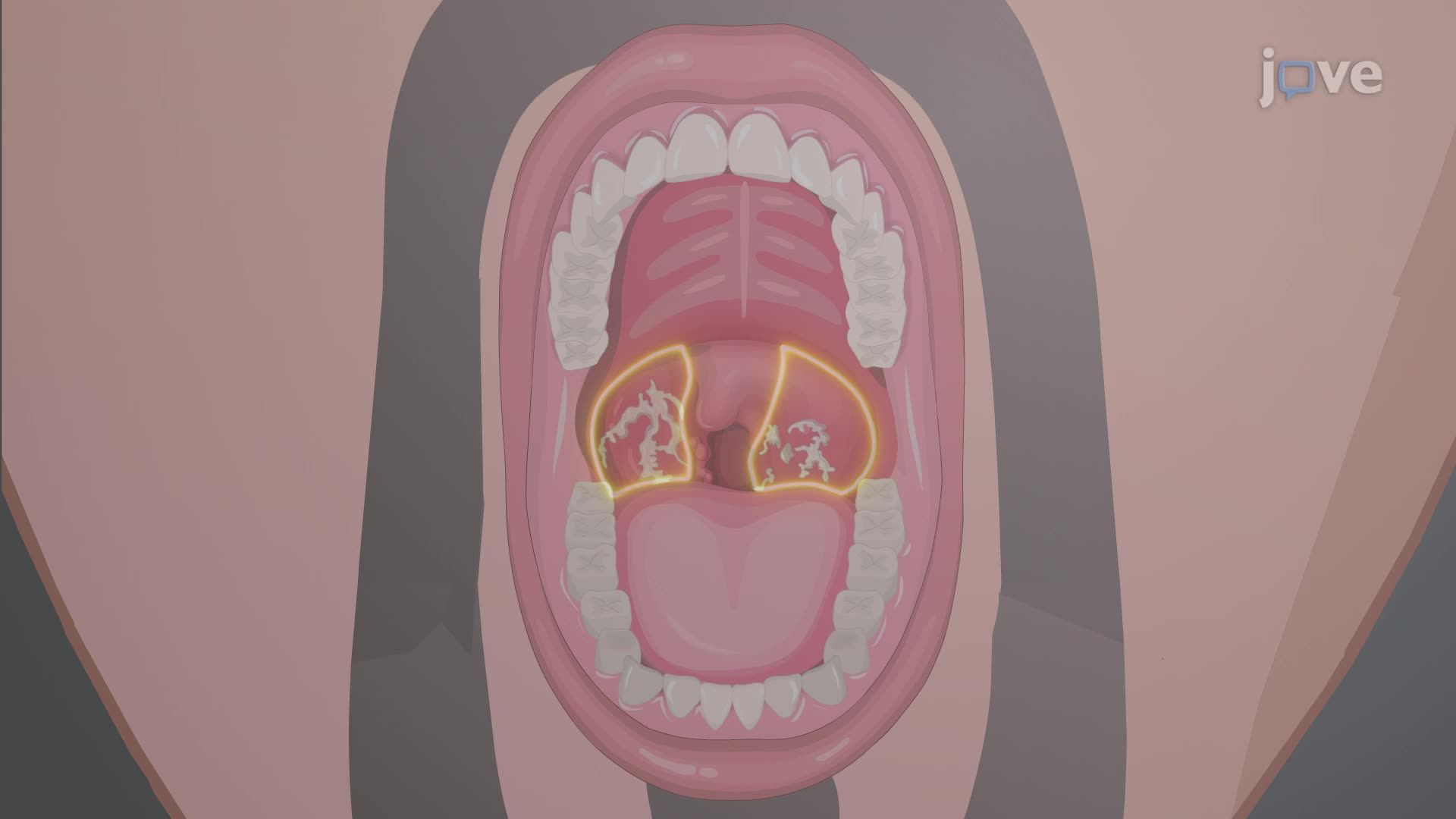 Rheumatic Heart Disease III: Medical Management