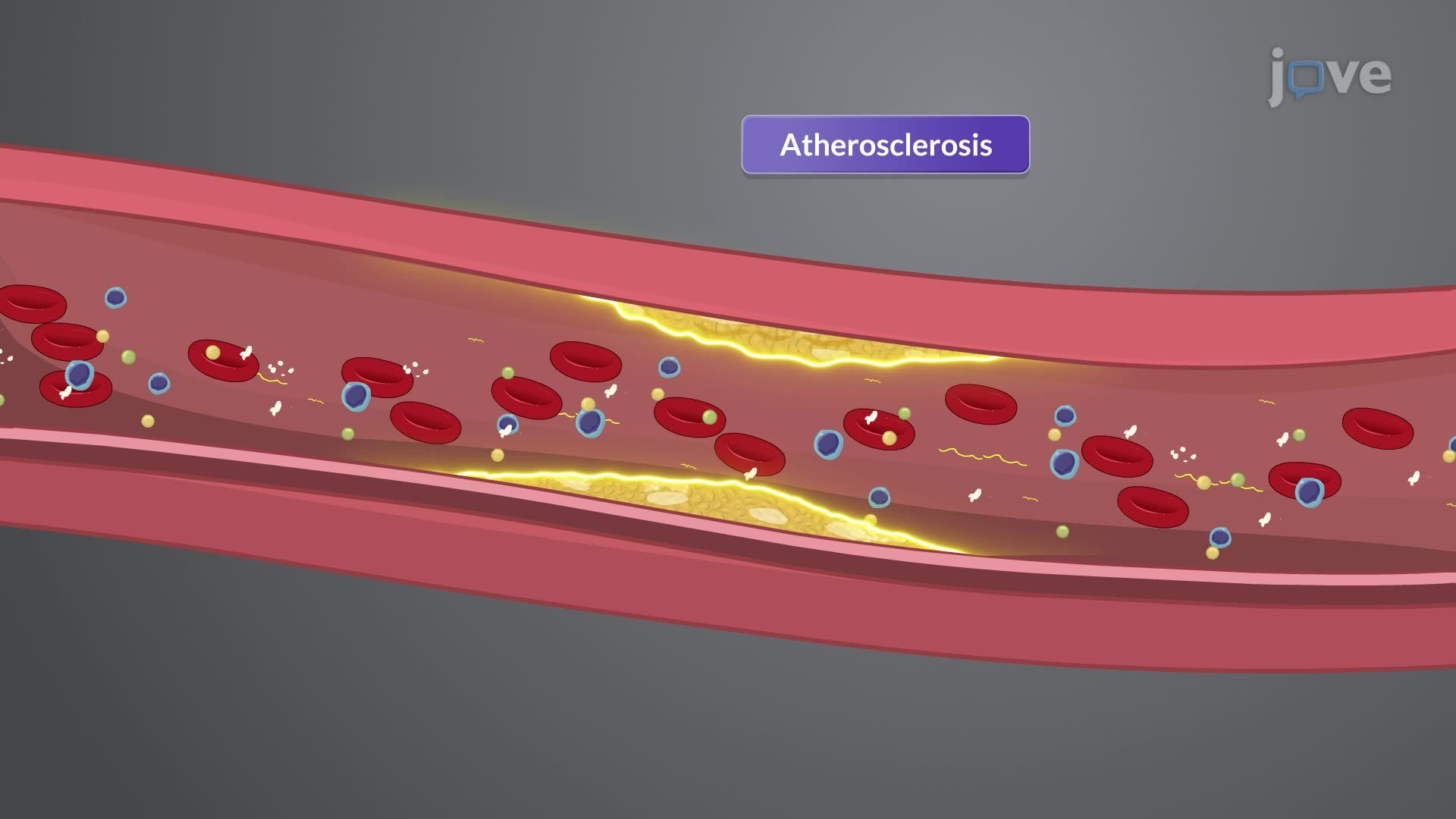 Coronary Artery Disease I: Introduction