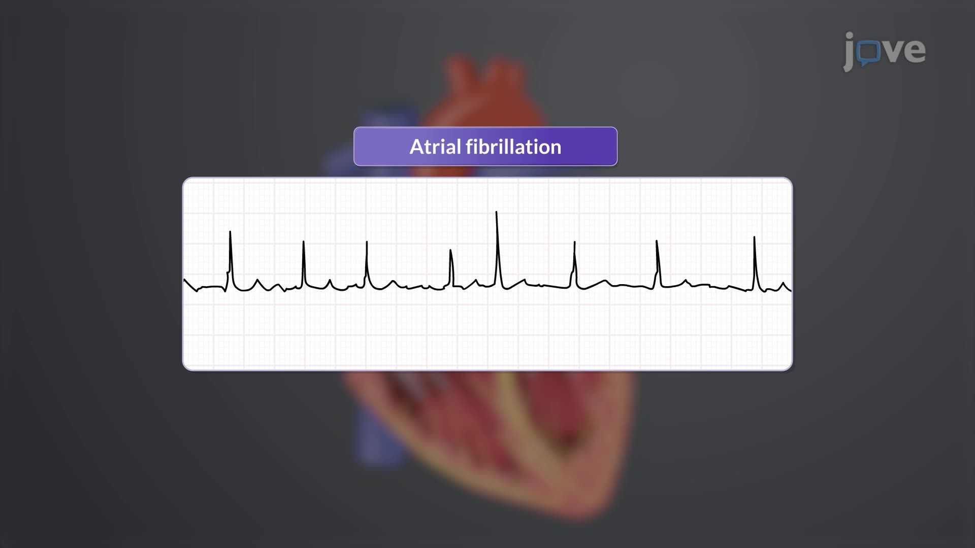 Coronary Artery Disease III: Clinical Manifestations