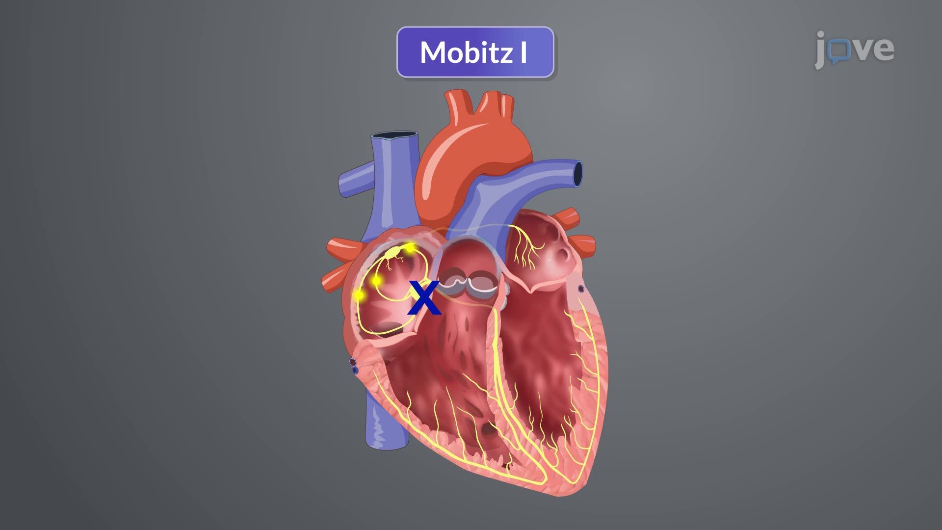 Dysrhythmias IV: Characteristics of Bradyarrhythmias