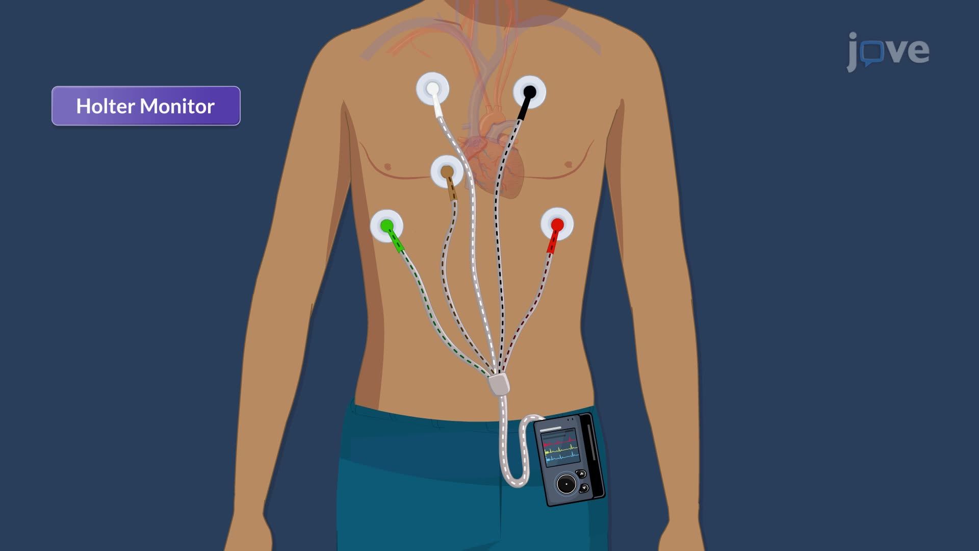Dysrhythmias V: Evaluating Dysrhythmias