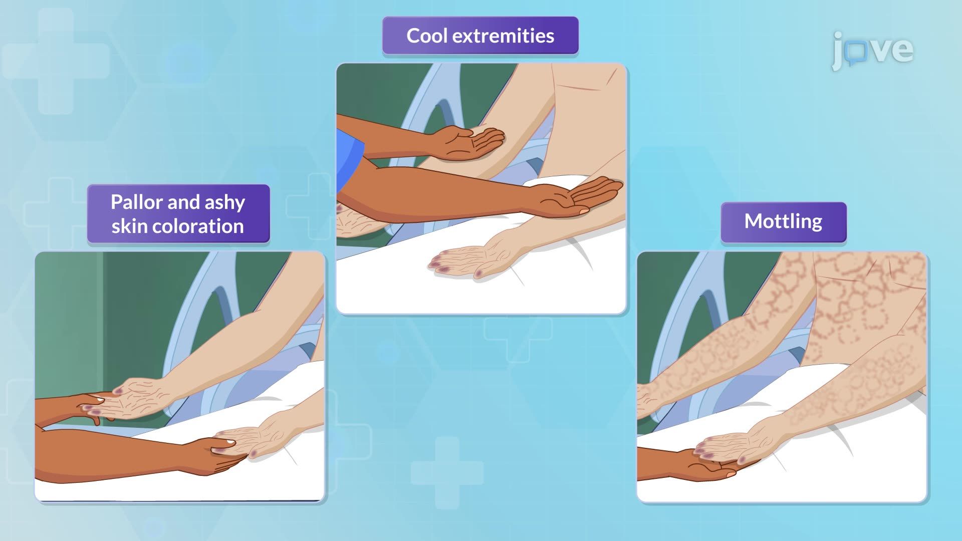 Heart Failure III: Clinical Manifestations