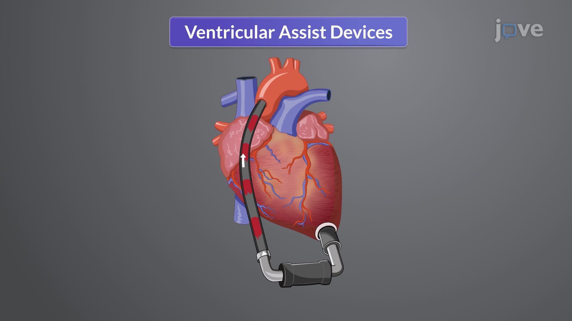 Heart Failure VI: Adjunct Therapies