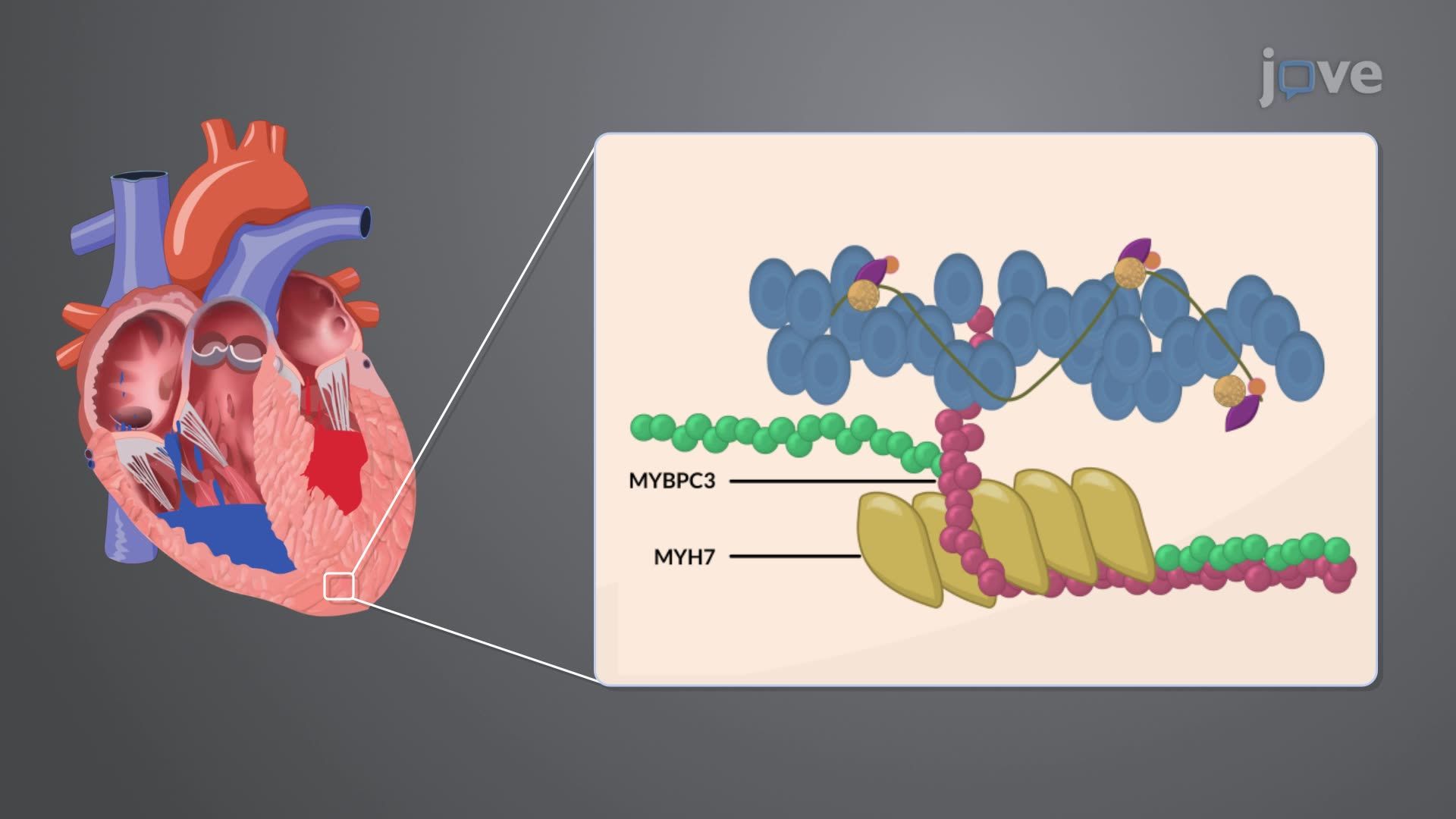 Cardiomyopathy III: Hypertrophic Cardiomyopathy