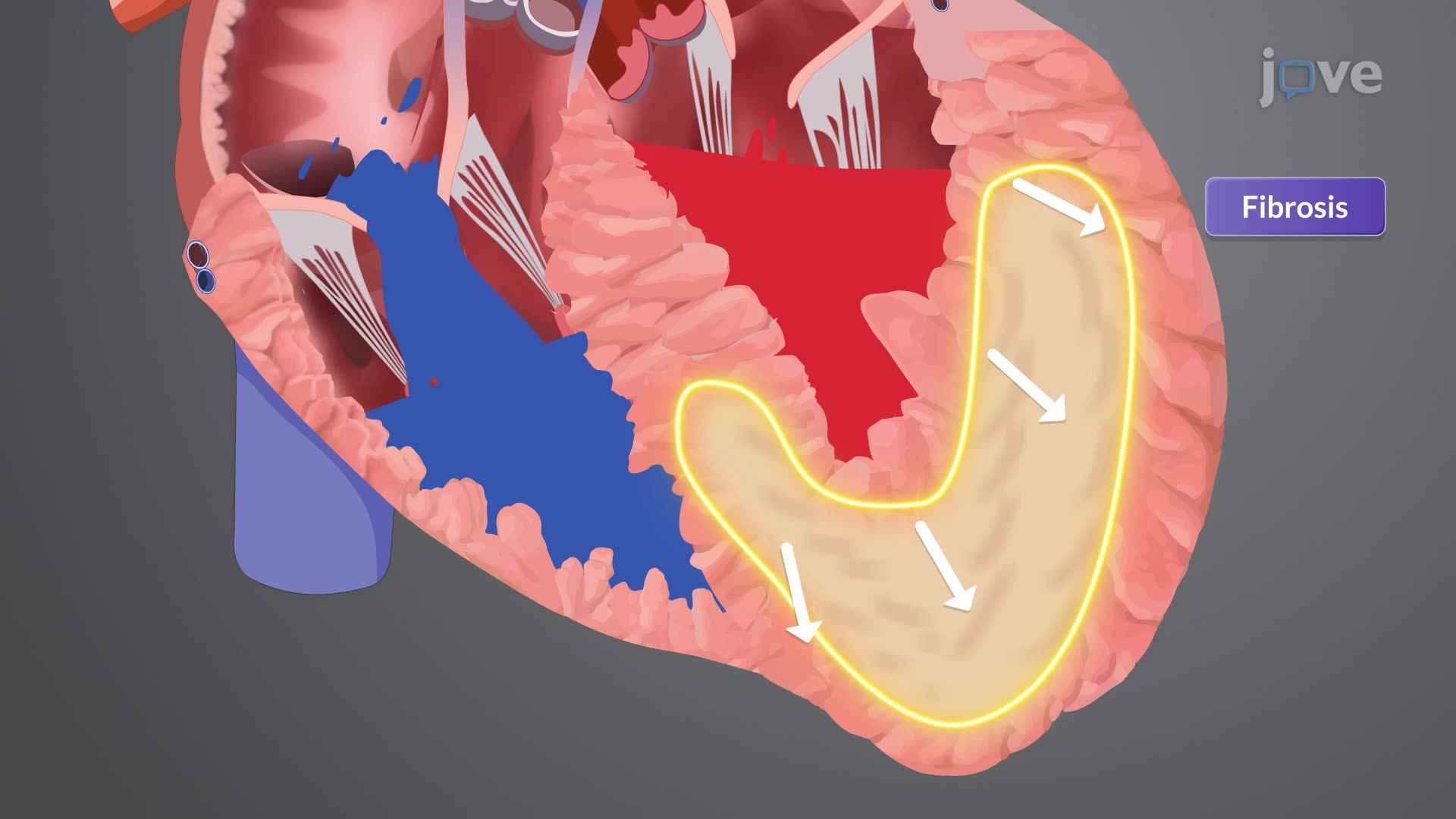 Cardiomyopathy IV: Restrictive Cardiomyopathy